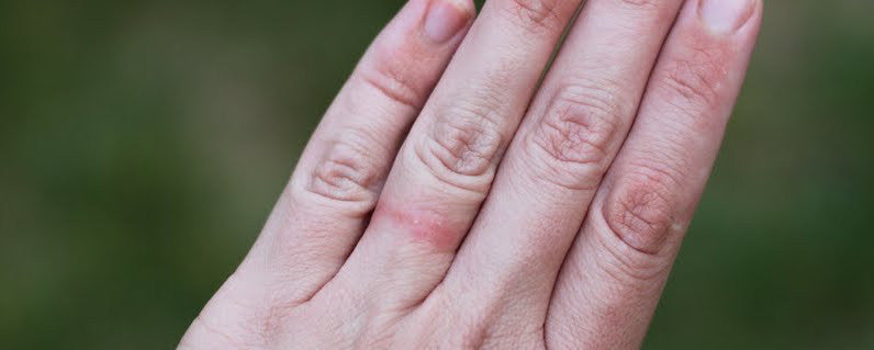 Are You Allergic To Your Wedding Ring?